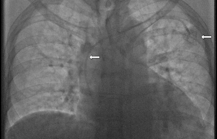 PaC Port to the right, catheter to the left